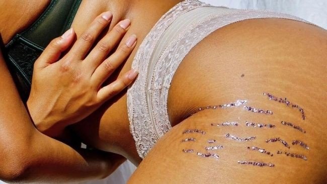 stretch-marks.jpg